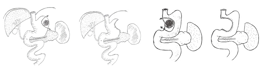 Gastrectomie coelioscopique atypique 