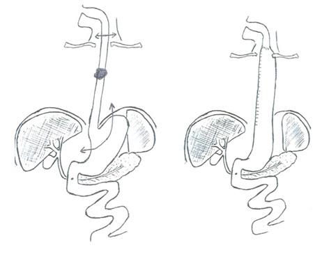 oesophagectomie totale 