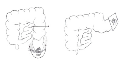 Résection antérieure avec coloscopie