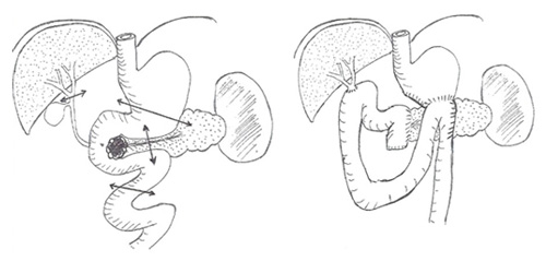 DUODENOPANCREATECTOMIE CEPHALIQUE 