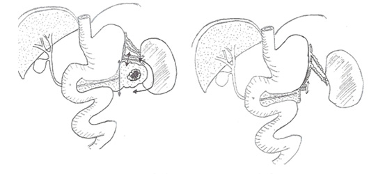 PANCREATECTOMIE GAUCHE COELIOSCOPIQUE 