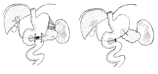 PANCREATECTOMIE CENTRALE AVEC REIMPLANTATION 