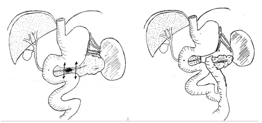 PANCREATECTOMIE CENTRALE AVEC REIMPLANTATION 