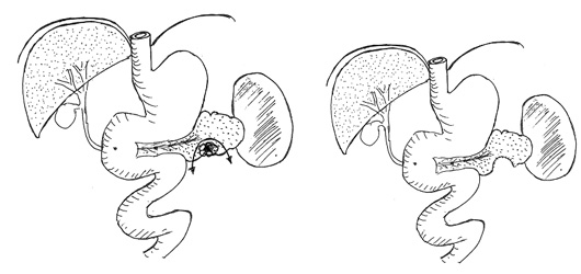 PANCREATECTOMIE ATYPIQUE 