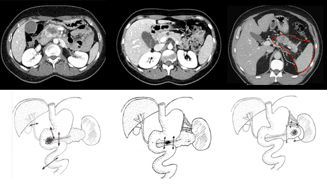 Schéma cancer pancréas