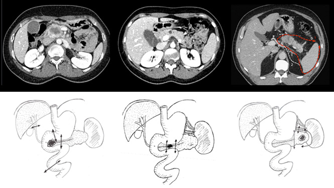 Schéma Cancer pancréas