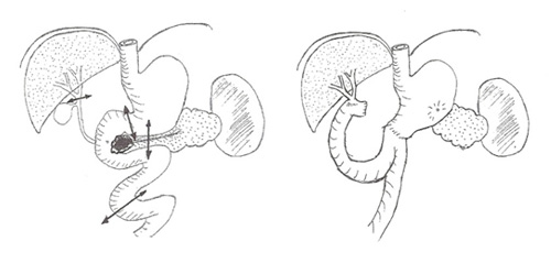 DUODENOPANCREATECTOMIE CEPHALIQUE 