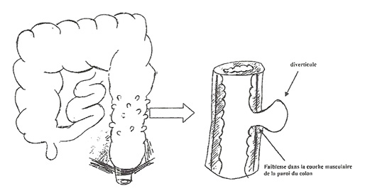 Diverticule colon sigmoïde