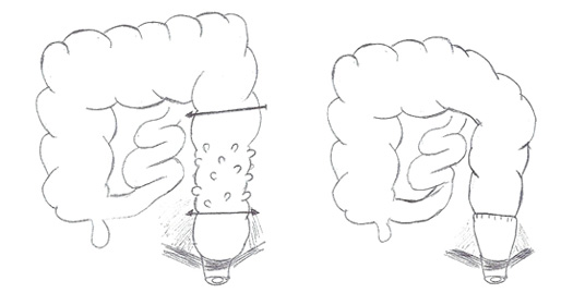 anastomose colo-rectale