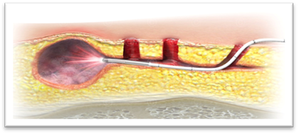 Illustration Behandlung Pilonidalsinus - MedicalGraphics